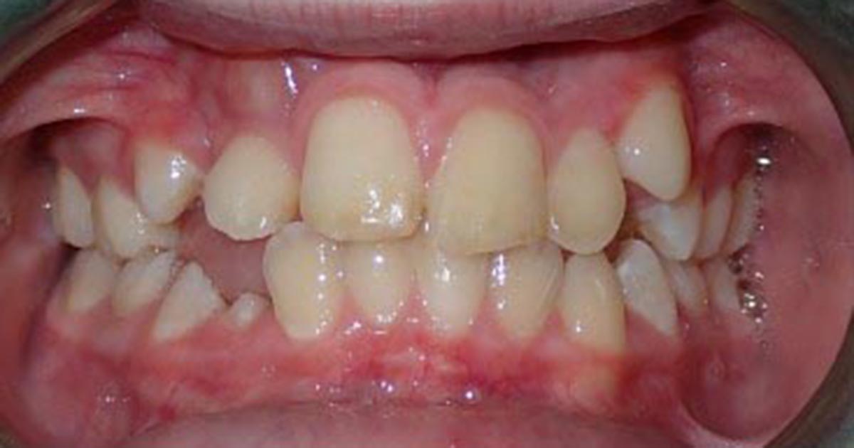 Before